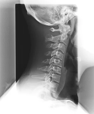 Spinal Degeneration Phase 3. Chiropractic Care For Spinal Degeneration.