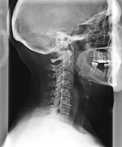 Spinal Degeneration Phase 2. Chiropractic Care For Spinal Degeneration.