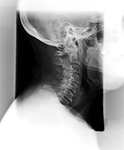 Spinal Degeneration Phase 4. Chiropractic Care For Spinal Degeneration.